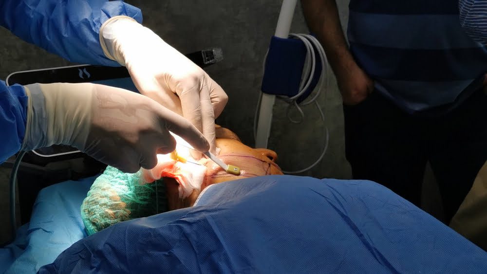 What is Facetite Procedure: Benefits, Complications, Recovery and Cost